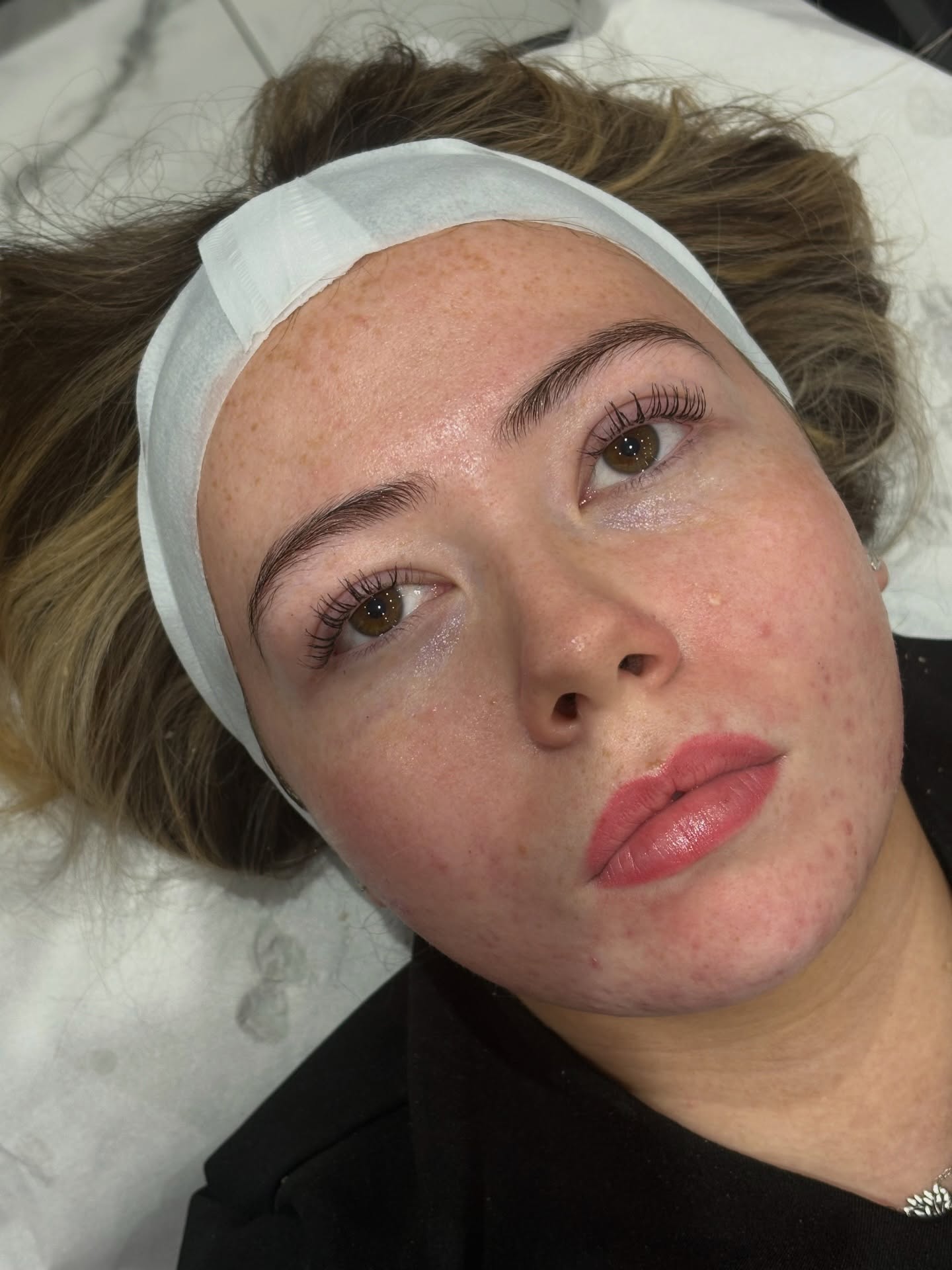 Dermaplaning facial treatment