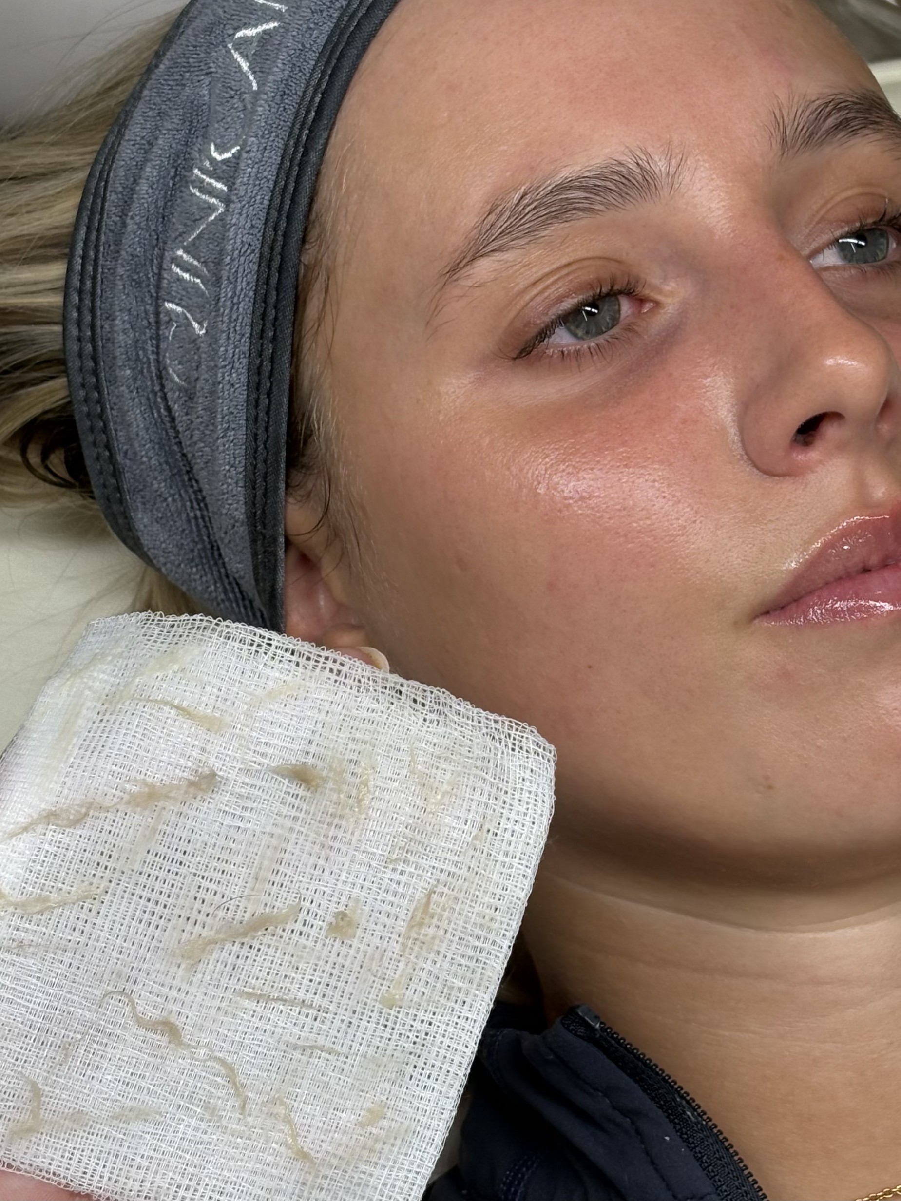 Dermaplaning facial treatment