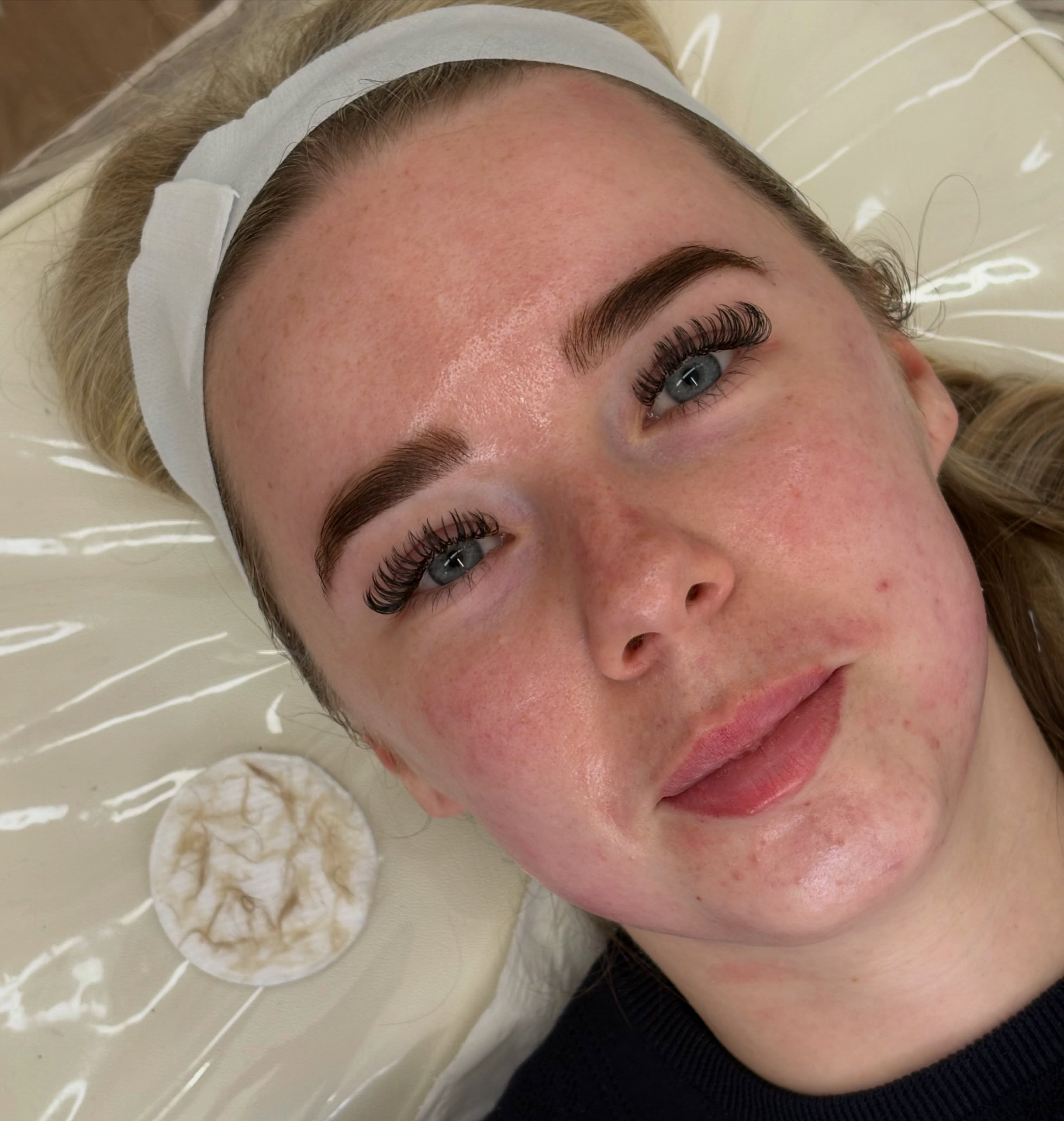 Skin treatment result