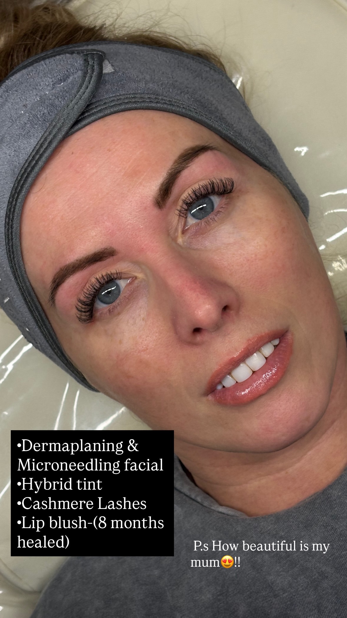 Microneedling treatment