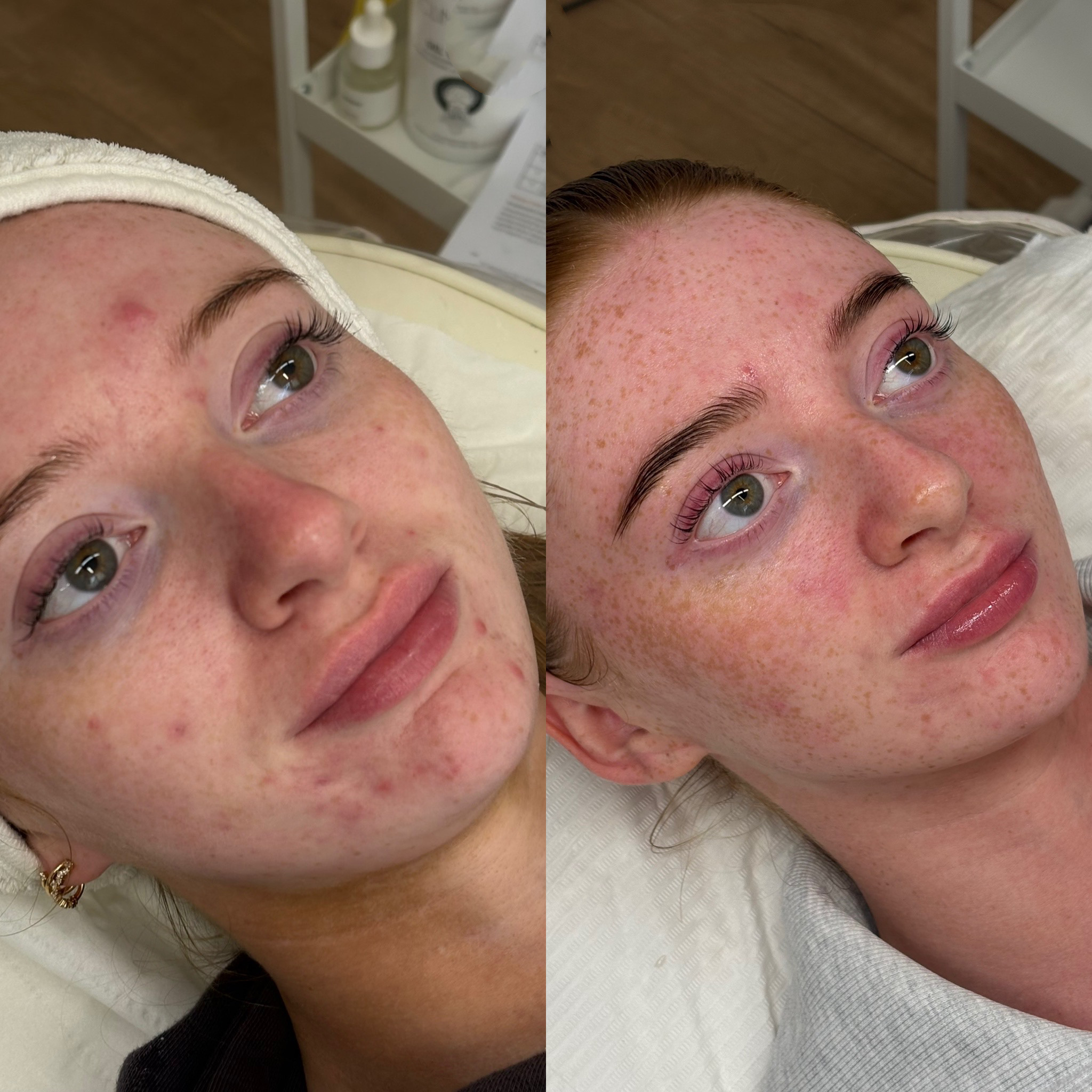 Chemical peel treatment