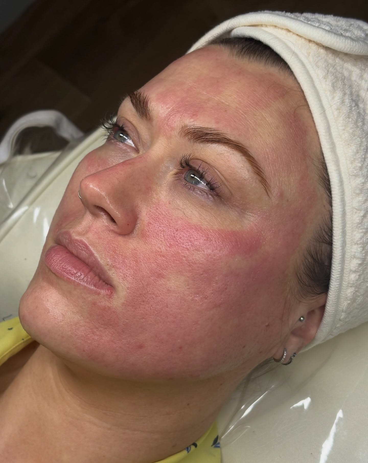 Chemical peel treatment